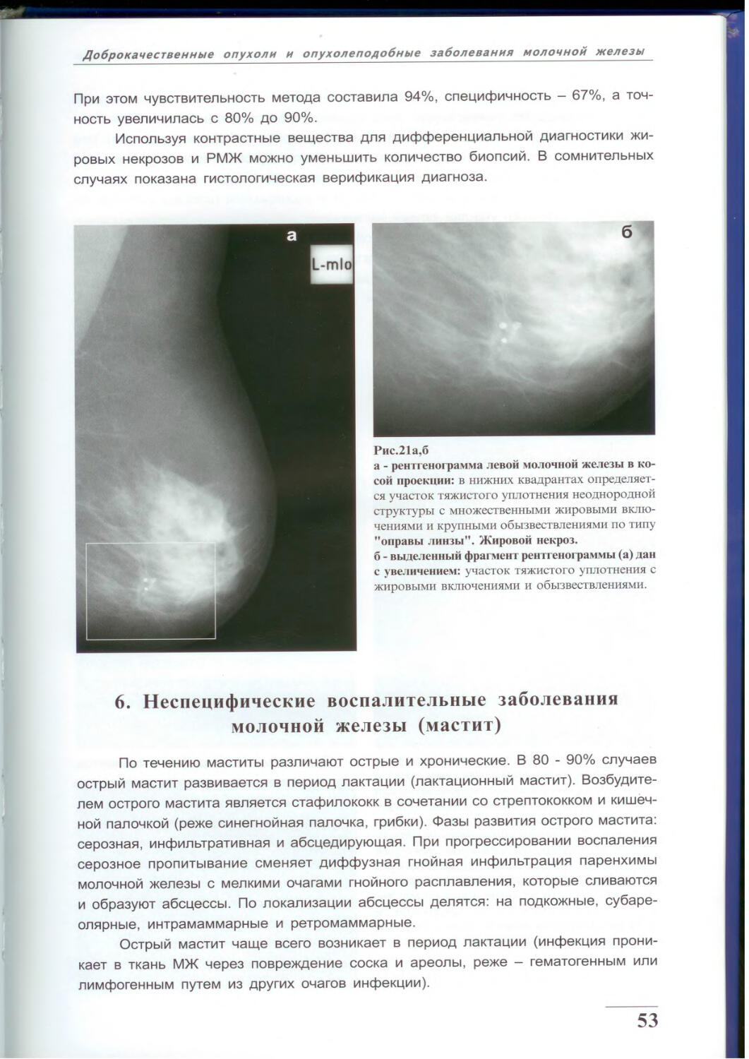 Норма молочной железы маммограмма