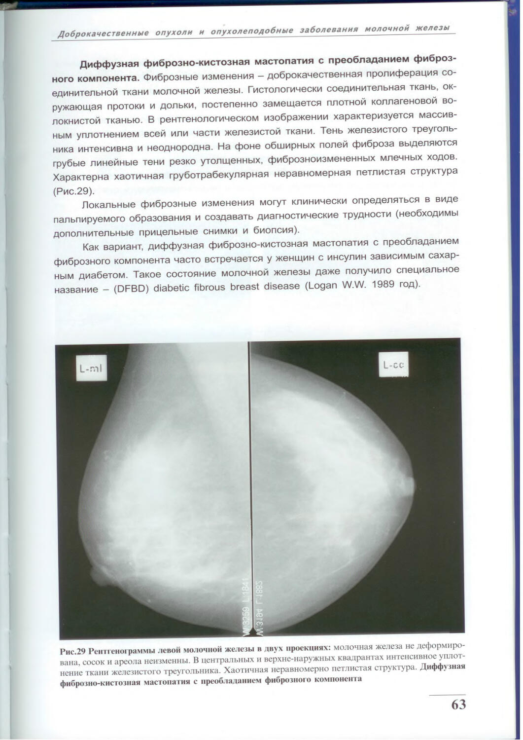 доброкачественные опухоли в груди у женщин фото 42