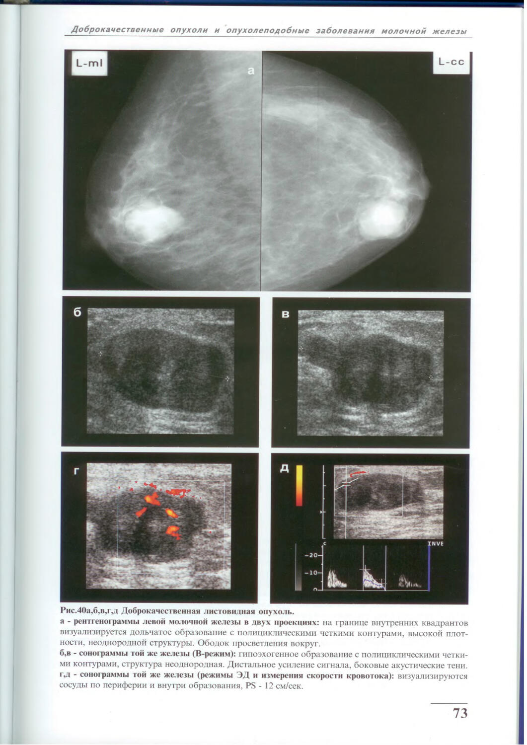 Листовидная опухоль молочной железы маммография
