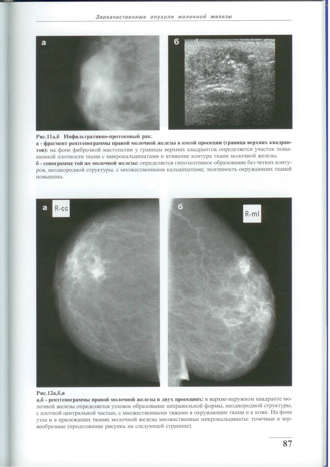 Гамартома молочной железы маммография