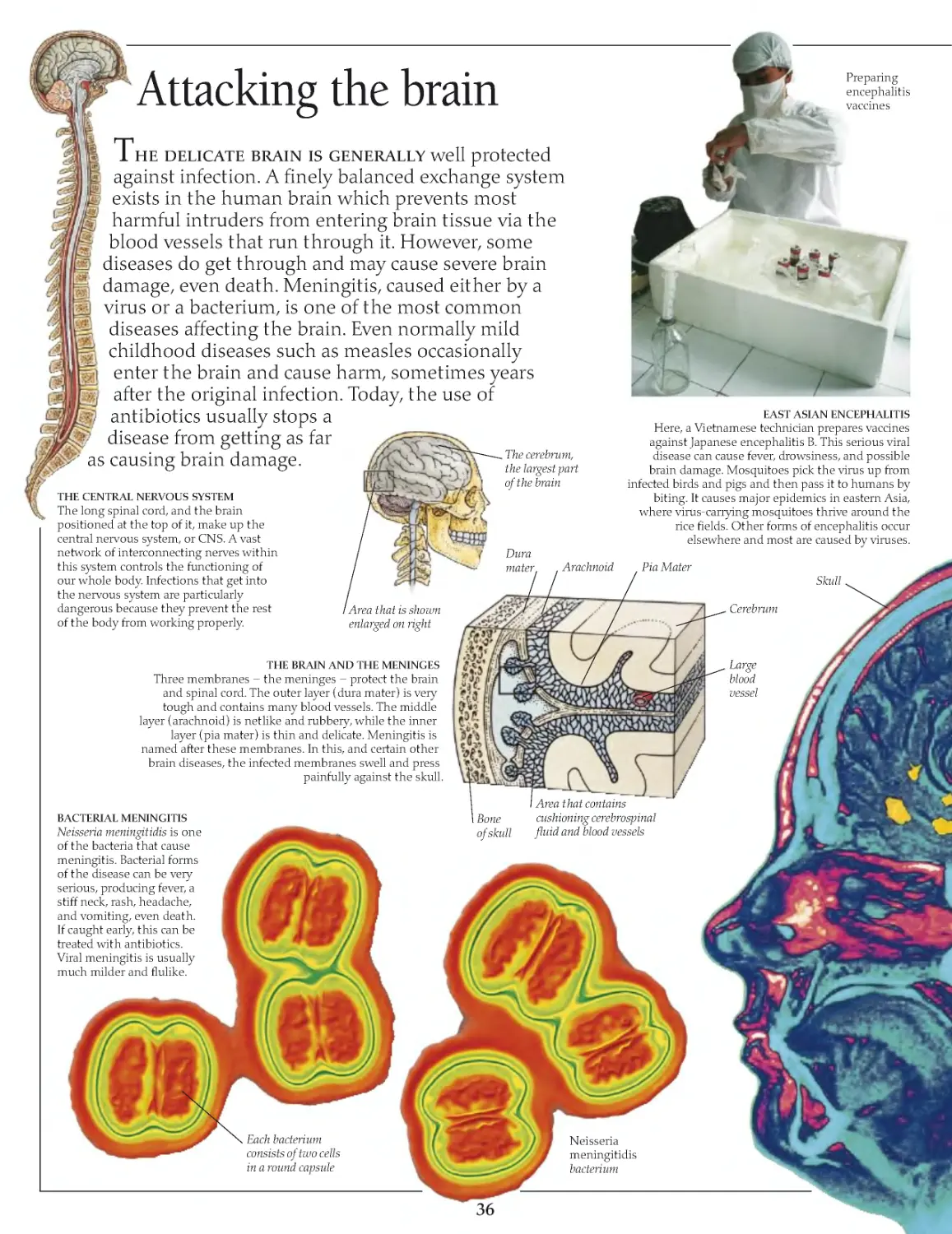 Attacking the brain