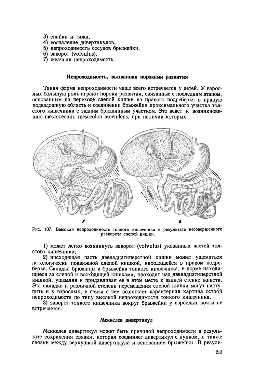 Непроходимость, вызванная пороками развития
Меккелев дивертикул