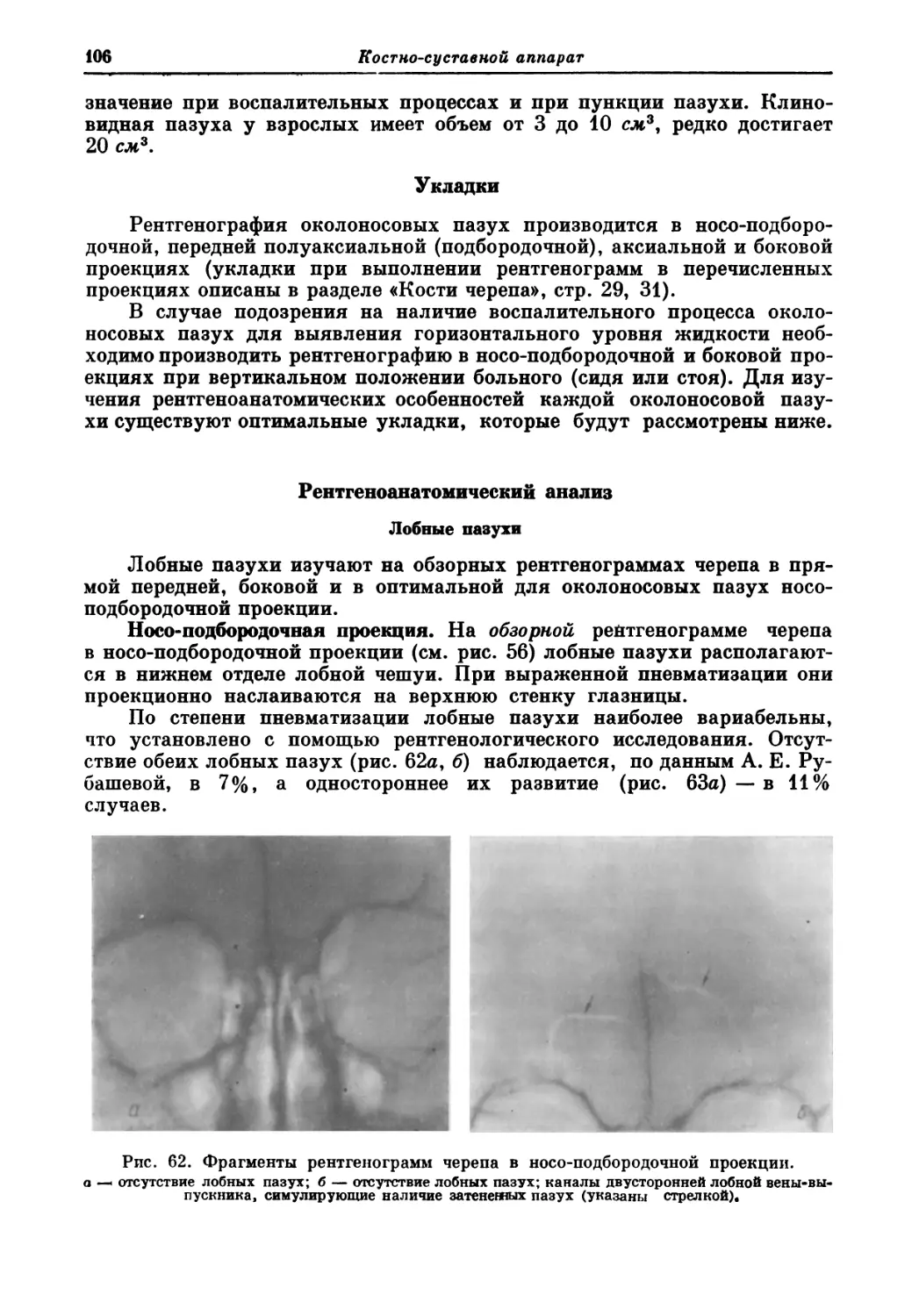 Укладки
Рентгеноанатомический анализ
Лобные пазухи