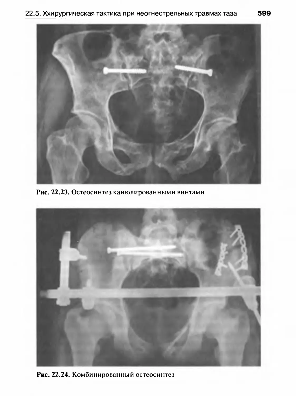 Остеосинтез костей таза рентген