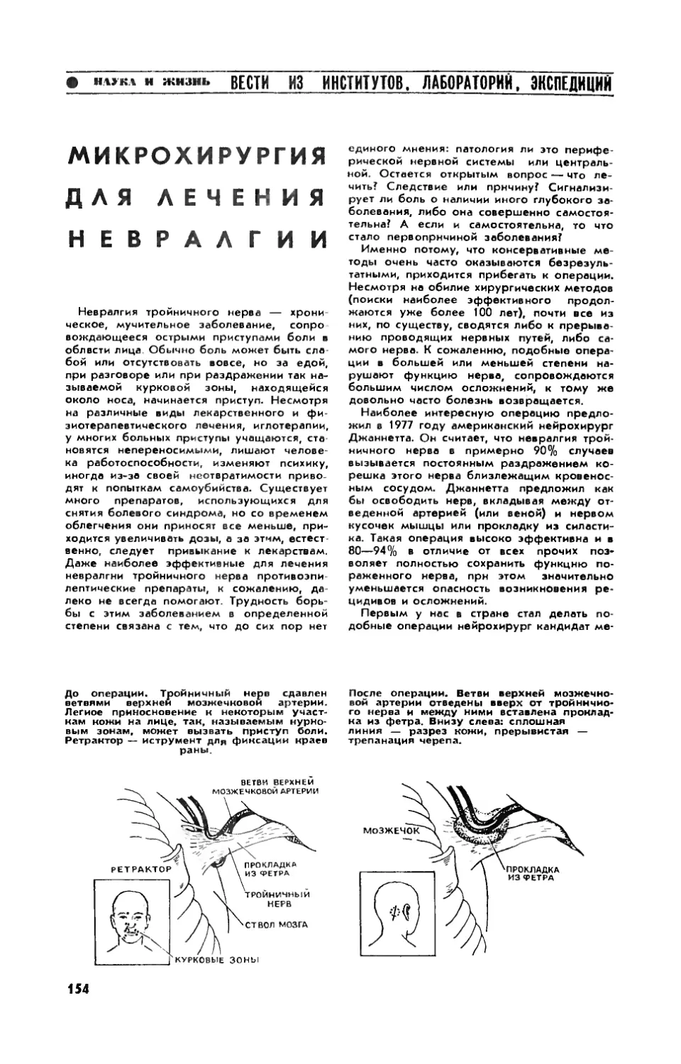 Микрохирургия для лечения невралгии