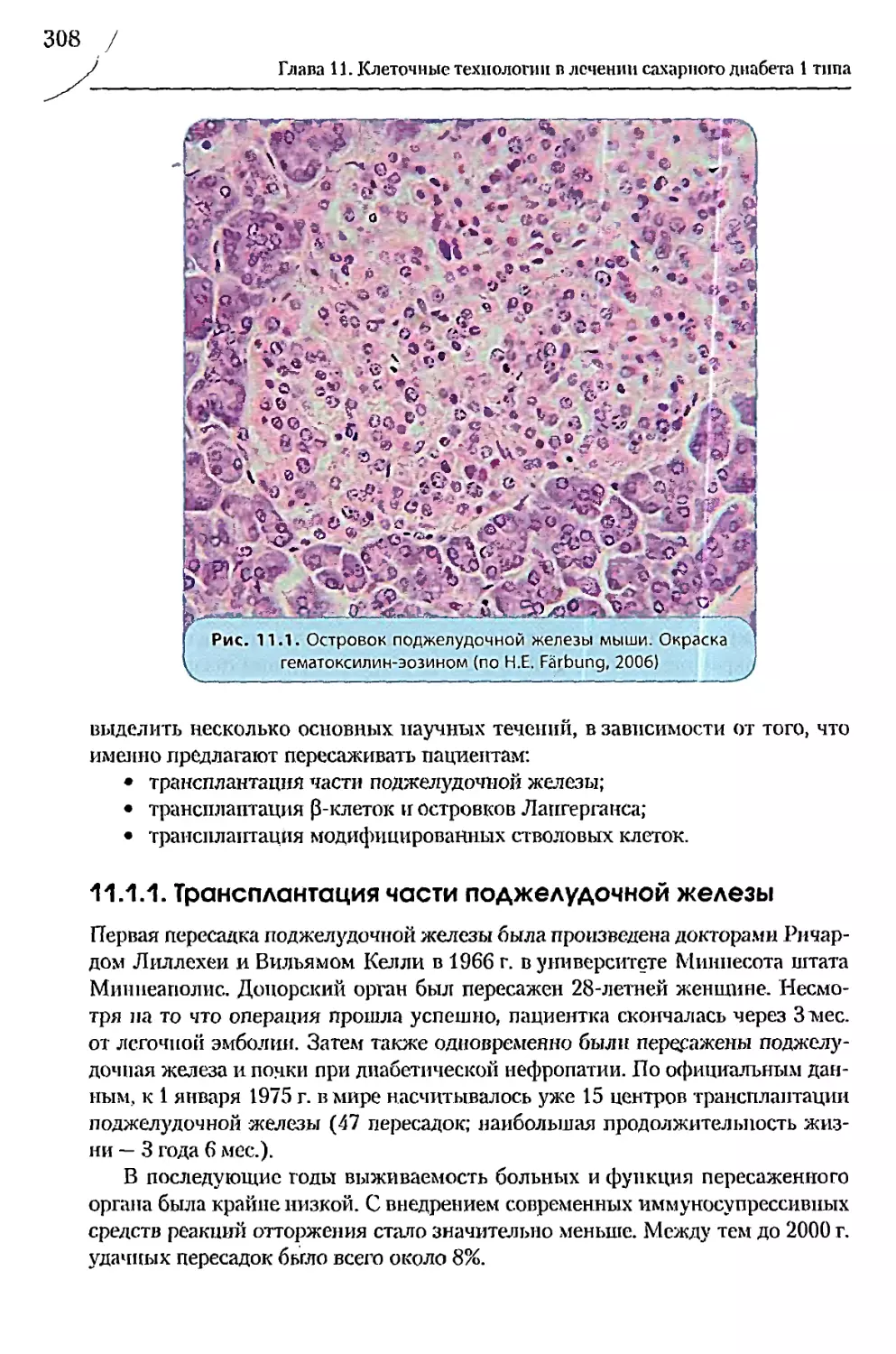 11.1.1. Трансплантация части поджелудочной железы