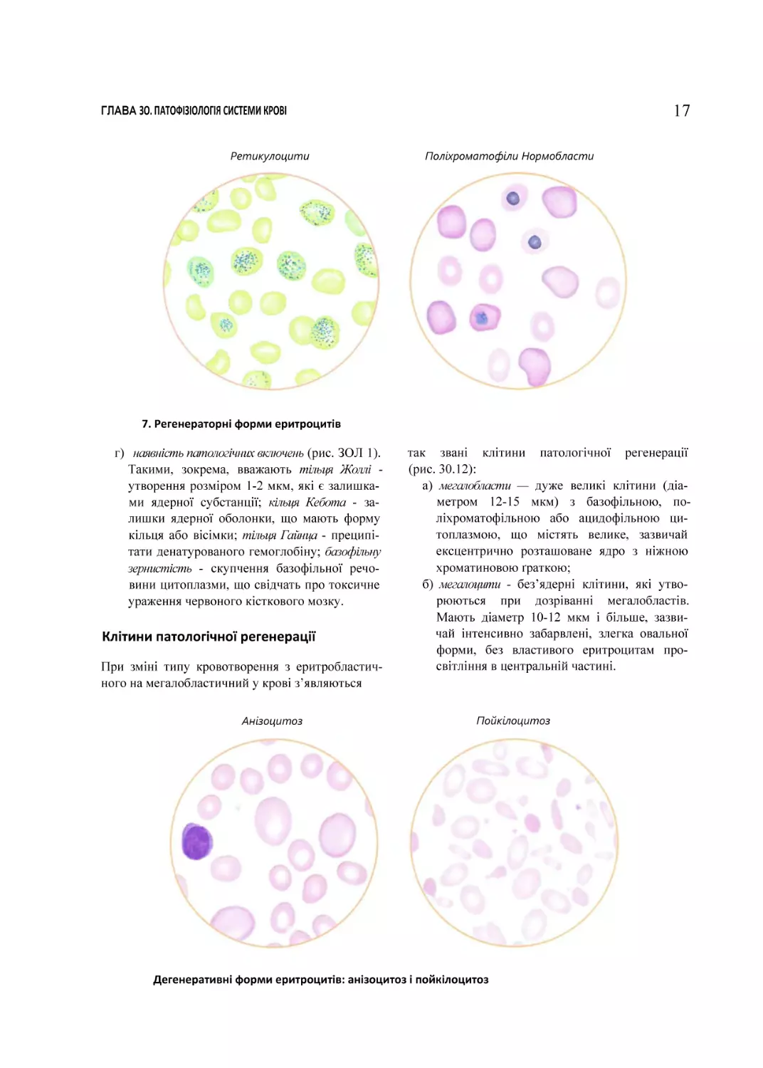 7. Регенераторні форми еритроцитів
Клітини патологічної регенерації
Дегенеративні форми еритроцитів