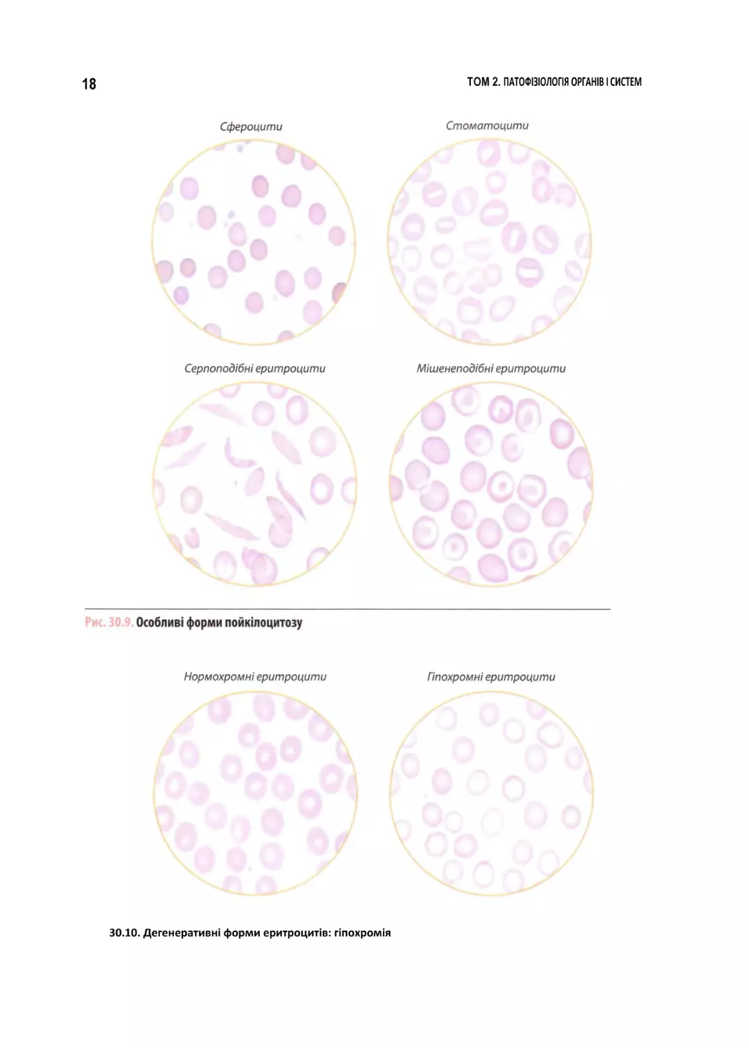 30.10. Дегенеративні форми еритроцитів