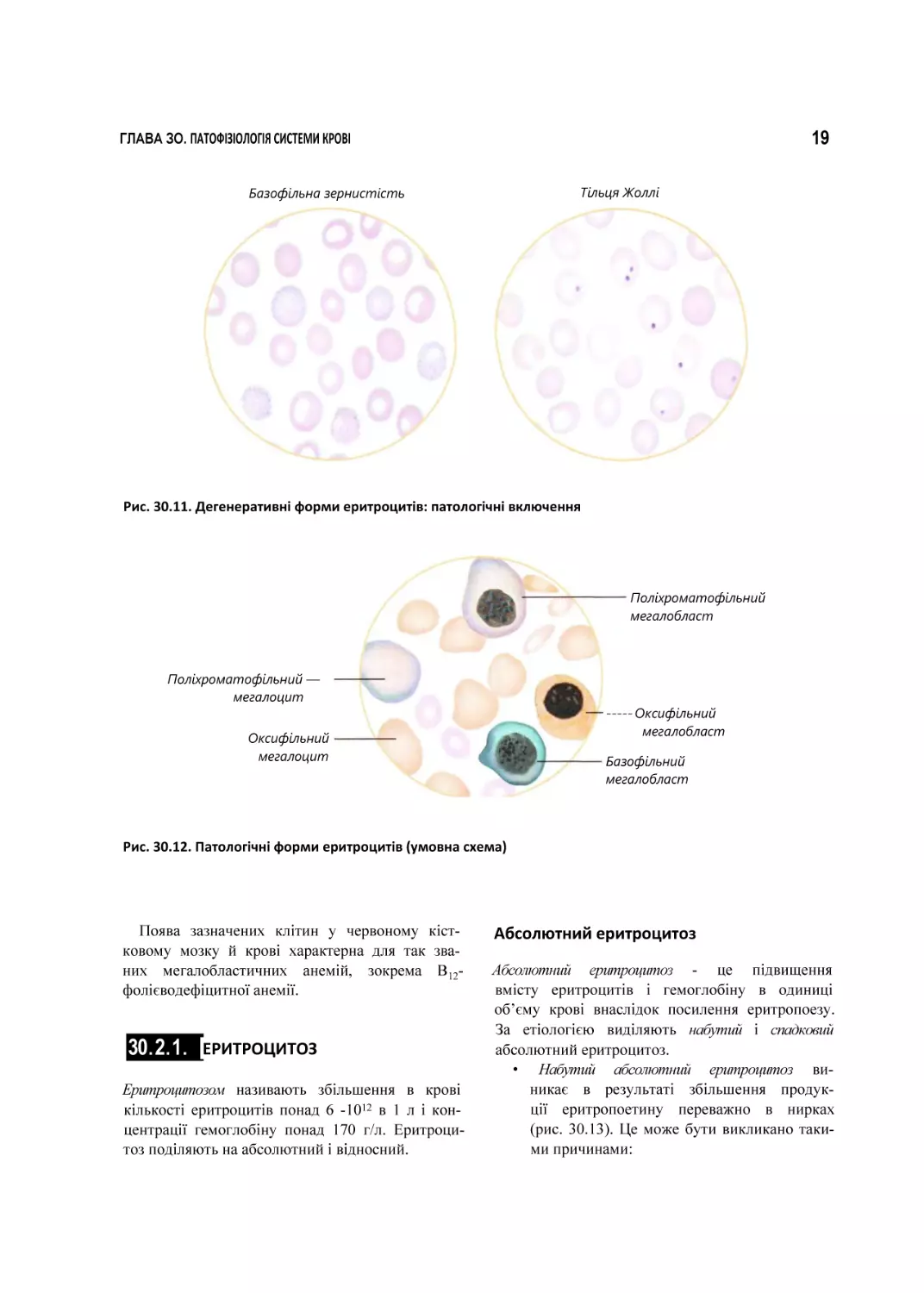 Рис. 30.11. Дегенеративні форми еритроцитів
Рис. 30.12. Патологічні форми еритроцитів (умовна схема)
ЕРИТРОЦИТОЗ
Абсолютний еритроцитоз
