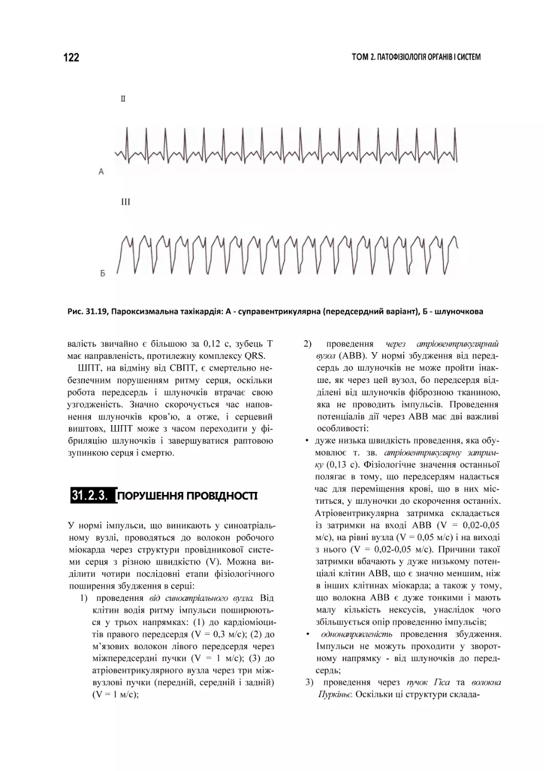 Рис. 31.19, Пароксизмальна тахікардія
ПОРУШЕННЯ ПРОВІДНОСТІ