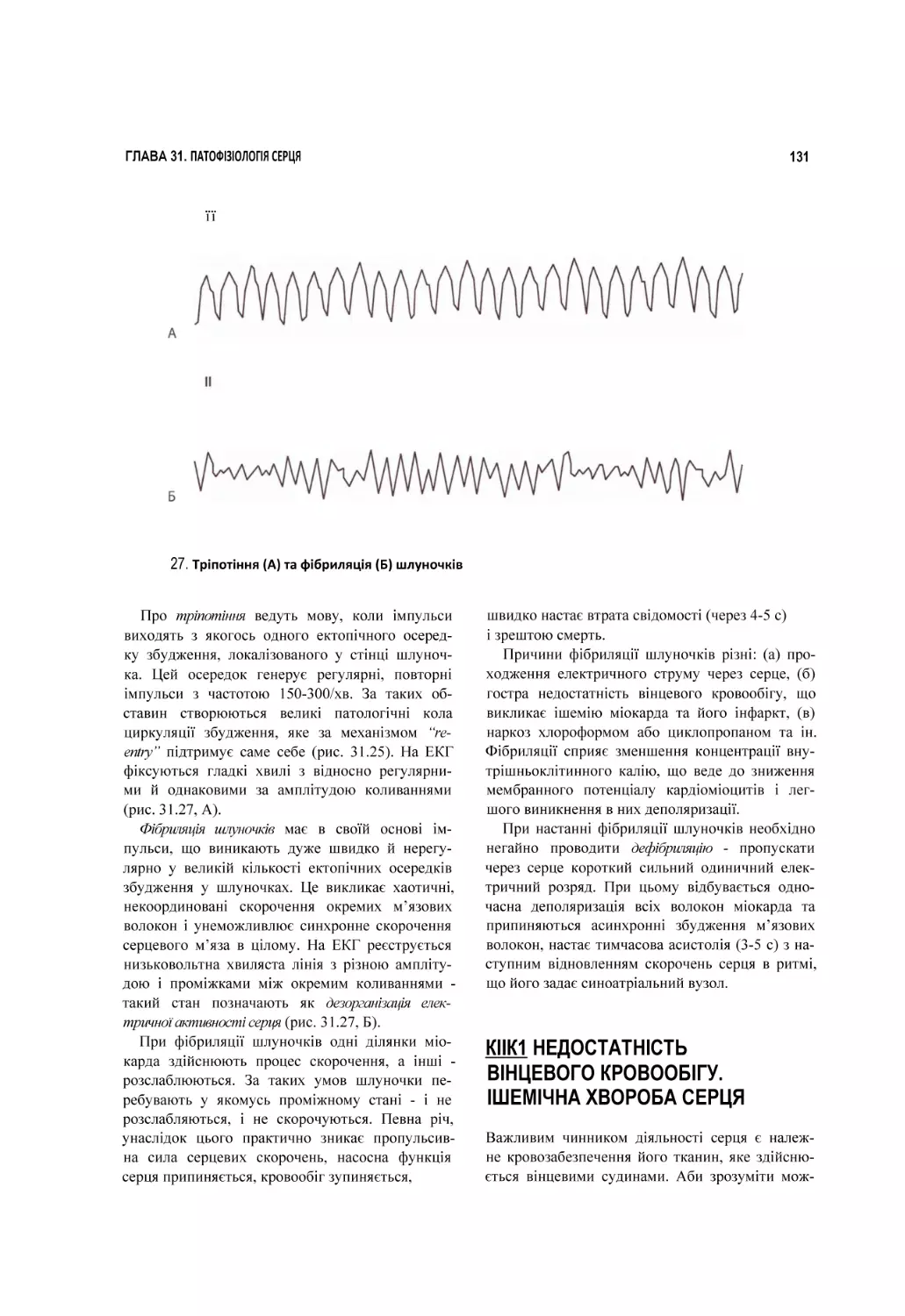 27. Тріпотіння (А) та фібриляція (Б) шлуночків
КІІК1 НЕДОСТАТНІСТЬ ВІНЦЕВОГО КРОВООБІГУ. ІШЕМІЧНА ХВОРОБА СЕРЦЯ