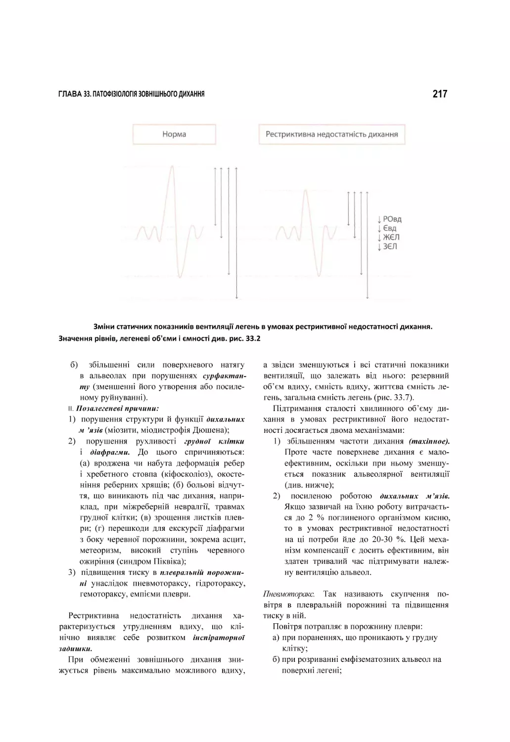 Зміни статичних показників вентиляції легень в умовах рестриктивної недостатності дихання. Значення рівнів, легеневі об'єми і ємності див. рис. 33.2