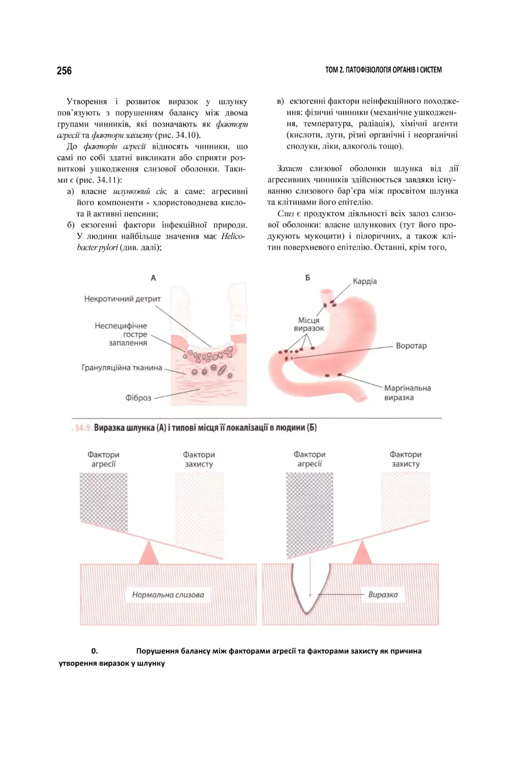 0.	Порушення балансу між факторами агресії та факторами захисту як причина утворення виразок у шлунку