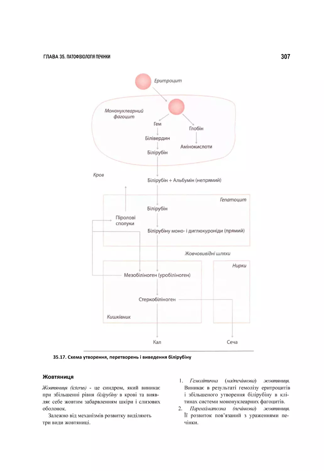 35.17. Схема утворення, перетворень і виведення білірубіну
Жовтяниця