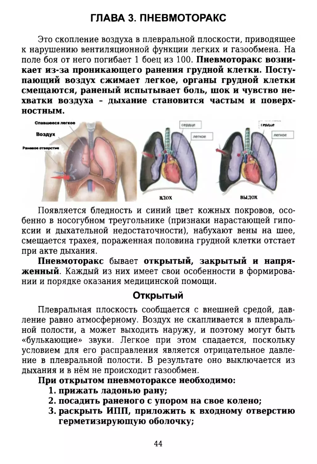 Глава 3. Пневмоторакс