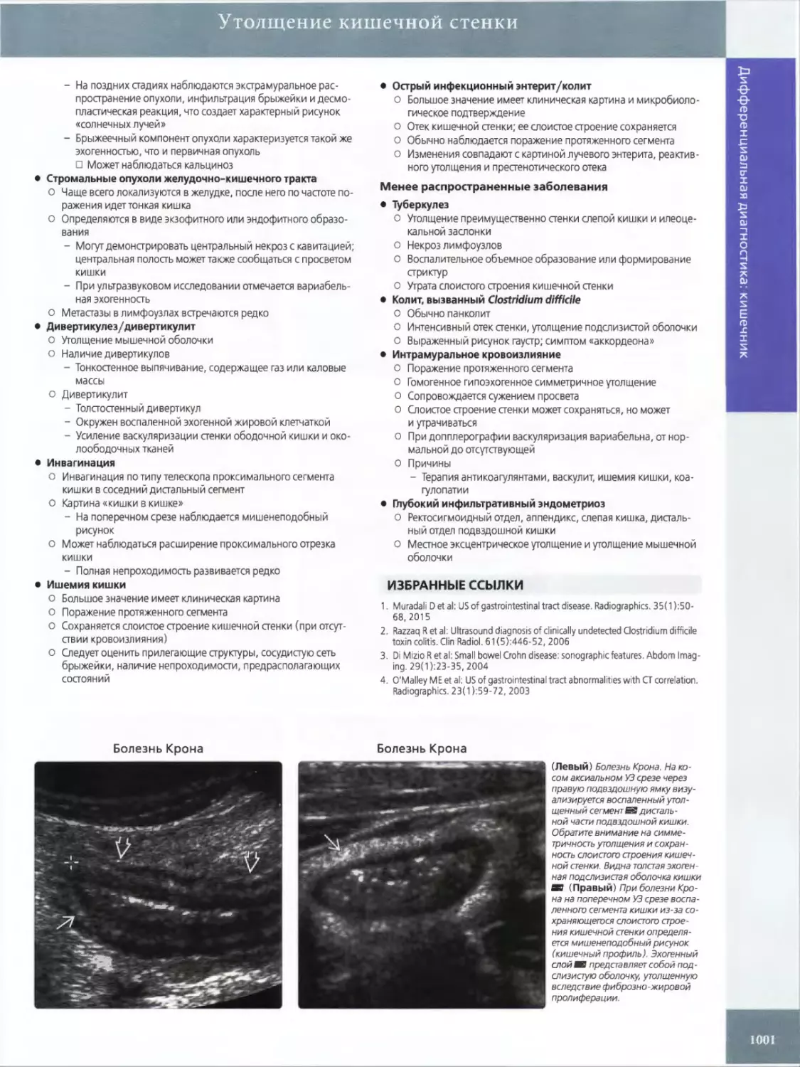 •	Стромальные опухоли желудочно-кишечного тракта
•	Ди верти кулез/ди верти кул ит
•	Инвагинация
•	Ишемия кишки
•	Острый инфекционный энтерит/колит
•	Туберкулез
•	Колит, вызванный Clostridium difficile
•	Интрамуральное кровоизлияние
•	Глубокий инфильтративный эндометриоз
ИЗБРАННЫЕ ССЫЛКИ