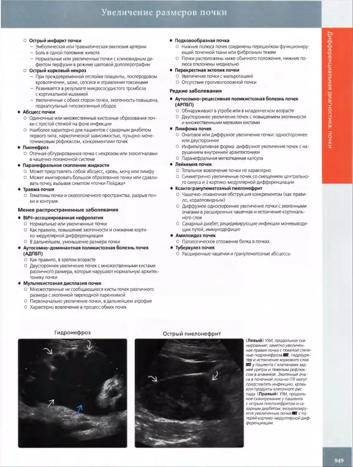 •	Абсцесс почки
•	Пионефроз
•	Паранефральное скопление жидкости
•	Травма почки
•	ВИЧ-ассоциированная нефропатия
•	Аутосомно-доминантная поликистозная болезнь почек (АДПБП)
•	Мультикистозная дисплазия почек
•	Подковообразная почка
•	Перекрестная эктопия почки
•	Аутосомно-рецессивная поликистозная болезнь почек (АРПБП)
•	Лимфома почек
•	Лейкемия почек
•	Ксантогранулематозный пиелонефрит
•	Амилоидоз почек
•	Туберкулез почек