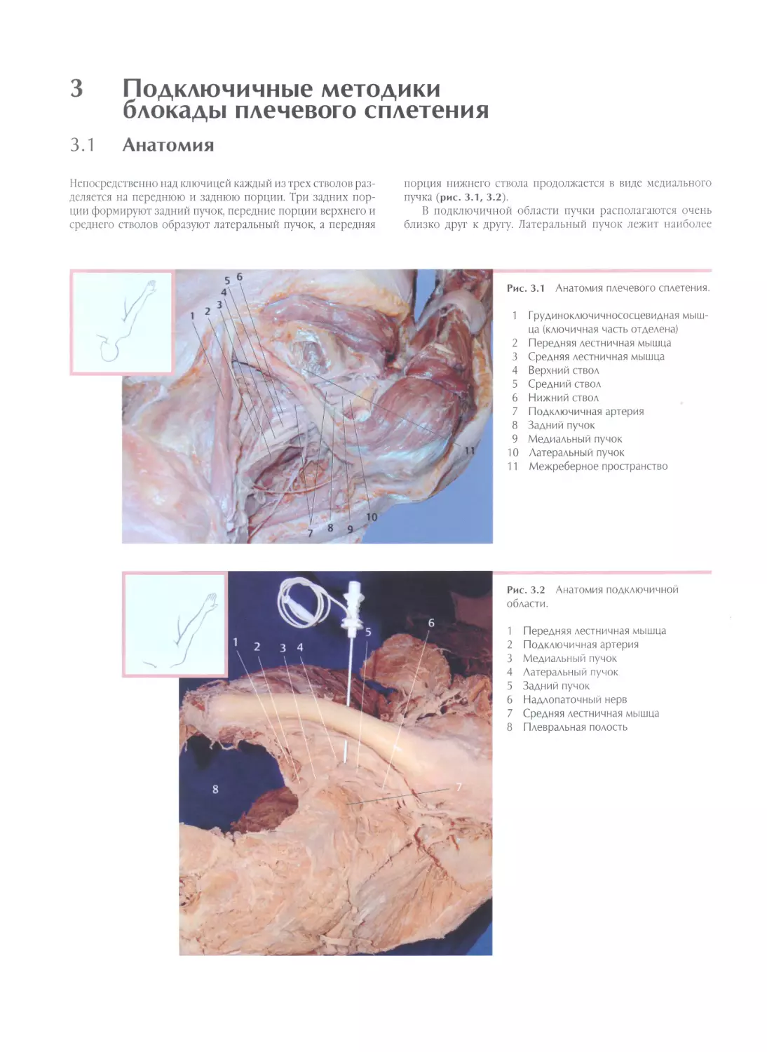 3. Подключичные методики блокады плечевого сплетения