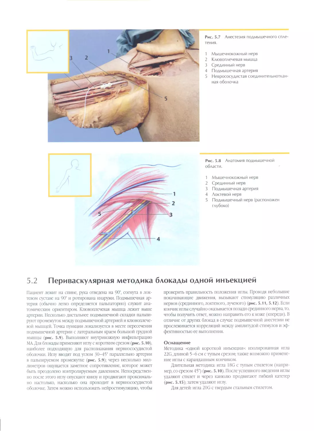 5.2. Периваскулярная методика блокады одной инъекцией