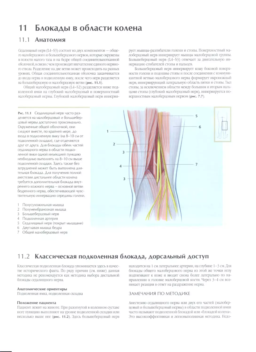 11. Блокады в области колена
11.2. Классическая подколенная блокада, дорсальный доступ