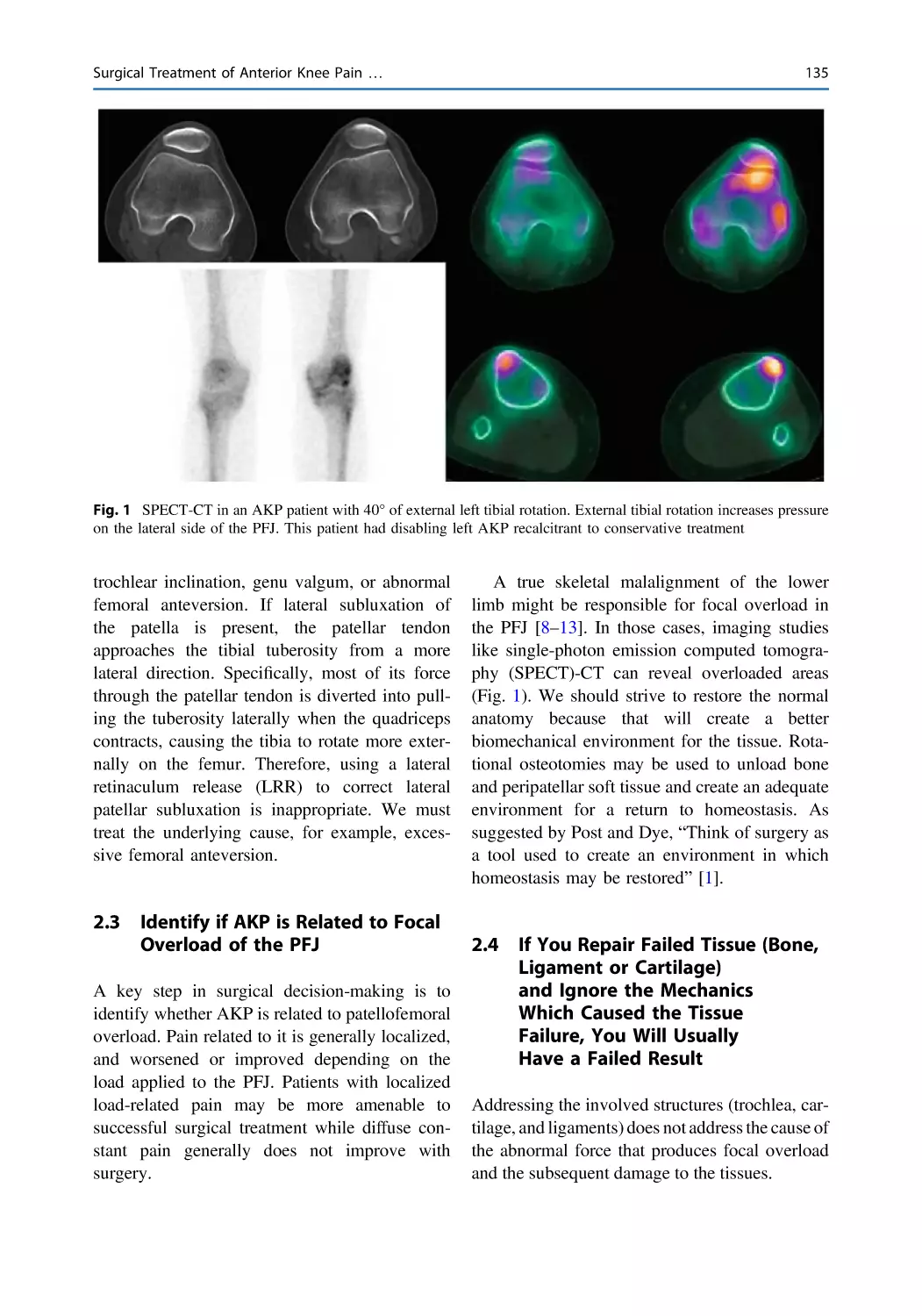 2.3 Identify if AKP is Related to Focal Overload of the PFJ
2.4 If You Repair Failed Tissue (Bone, Ligament or Cartilage) and Ignore the Mechanics Which Caused the Tissue Failure, You Will Usually Have a Failed Result