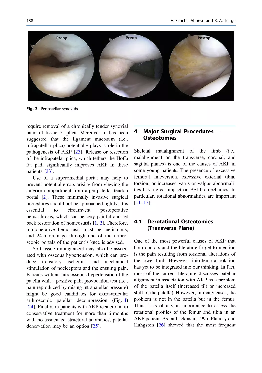 4 Major Surgical Procedures—Osteotomies
4.1 Derotational Osteotomies (Transverse Plane)