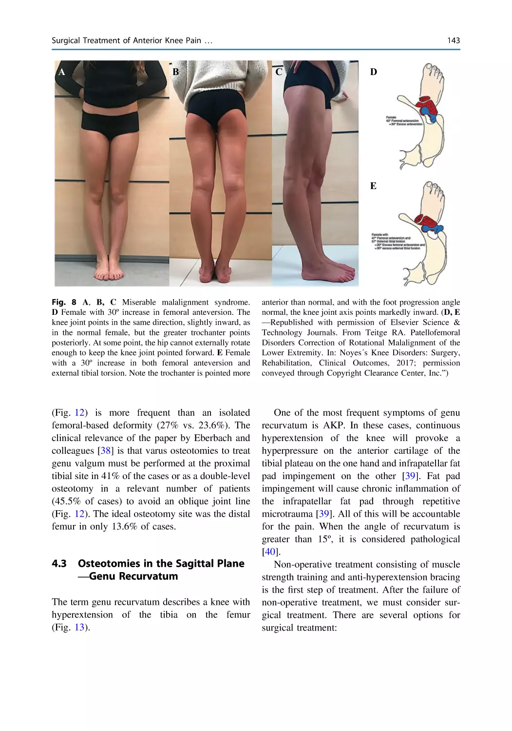 4.3 Osteotomies in the Sagittal Plane—Genu Recurvatum