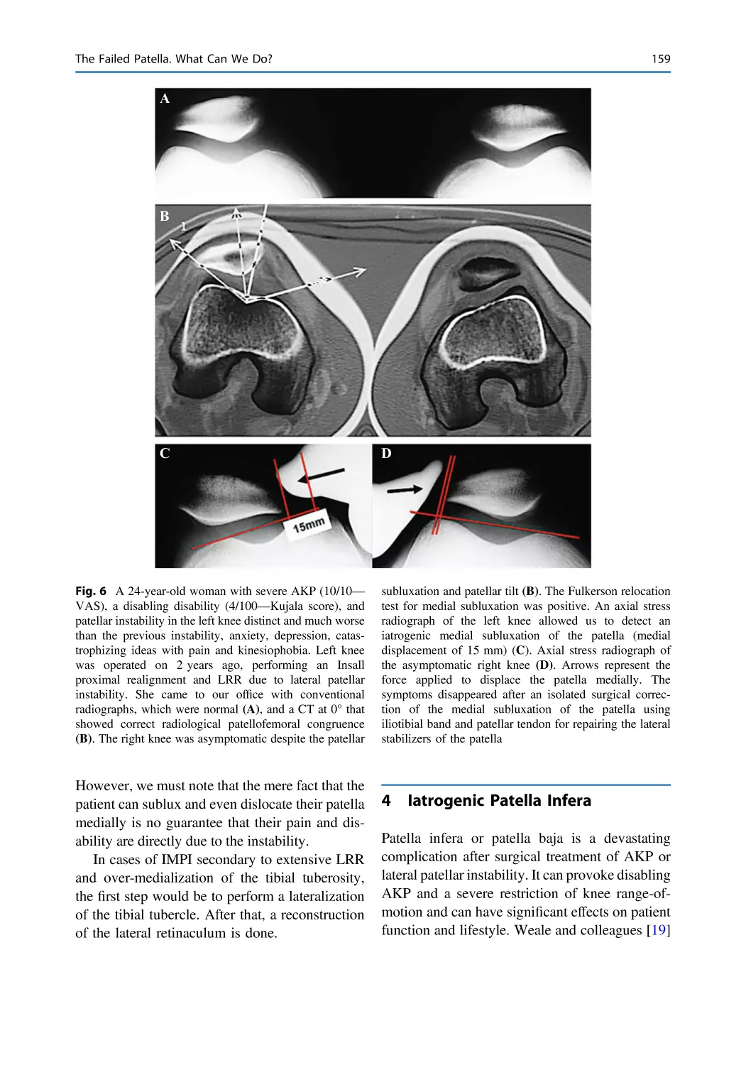 4 Iatrogenic Patella Infera