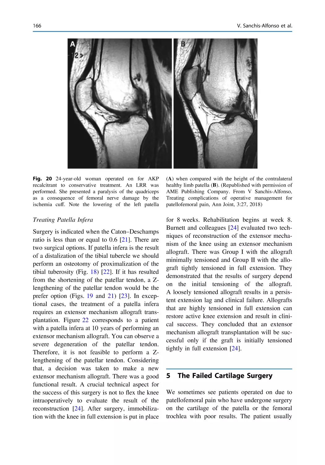 5 The Failed Cartilage Surgery