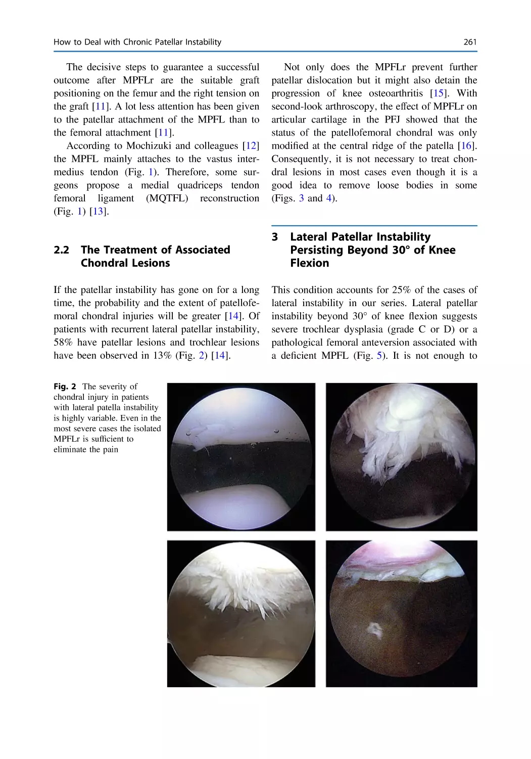 2.2 The Treatment of Associated Chondral Lesions
3 Lateral Patellar Instability Persisting Beyond 30° of Knee Flexion