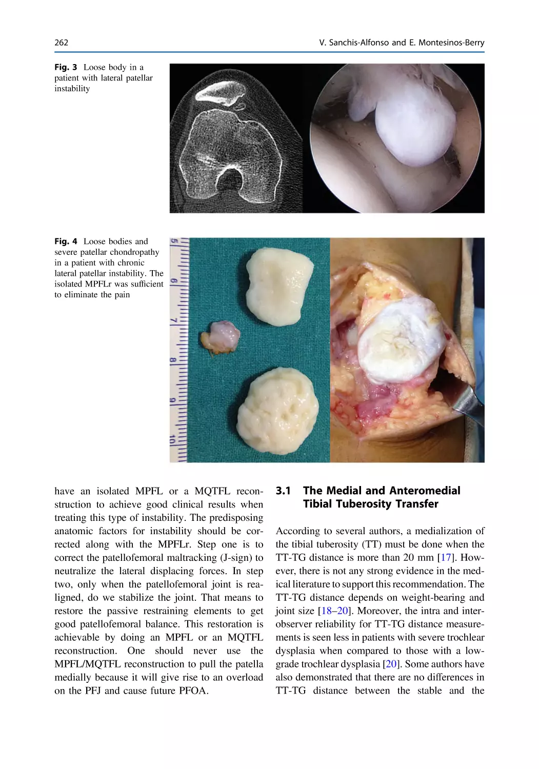 3.1 The Medial and Anteromedial Tibial Tuberosity Transfer