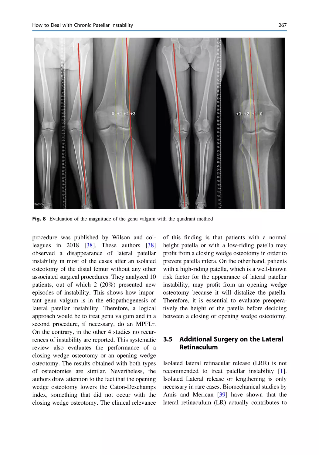 3.5 Additional Surgery on the Lateral Retinaculum