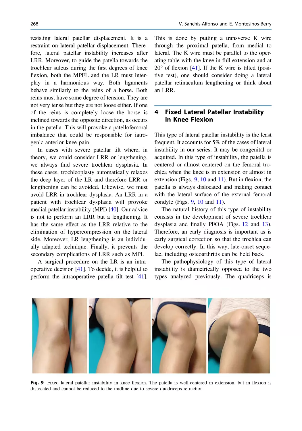 4 Fixed Lateral Patellar Instability in Knee Flexion