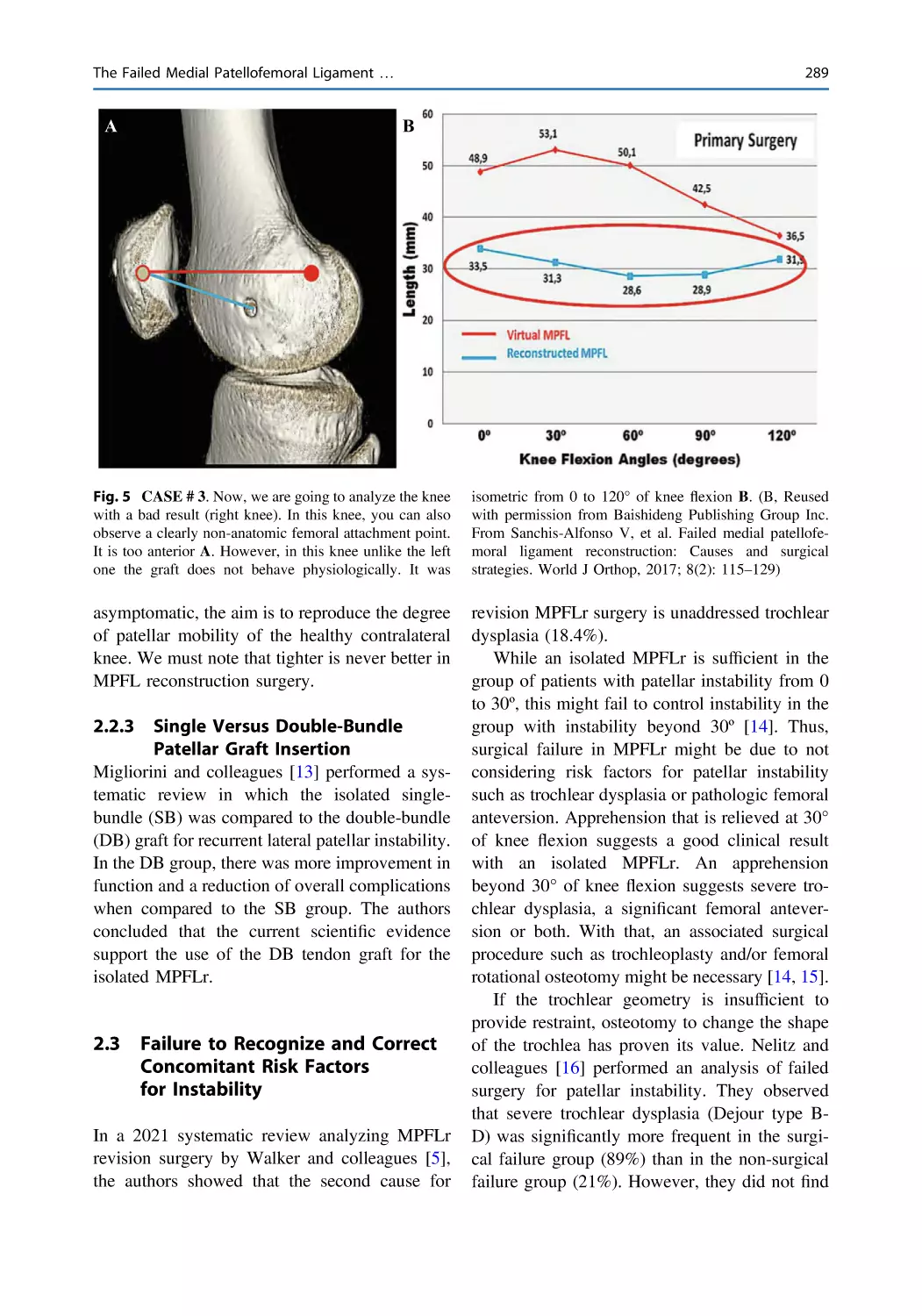 2.2.3 Single Versus Double-Bundle Patellar Graft Insertion
2.3 Failure to Recognize and Correct Concomitant Risk Factors for Instability