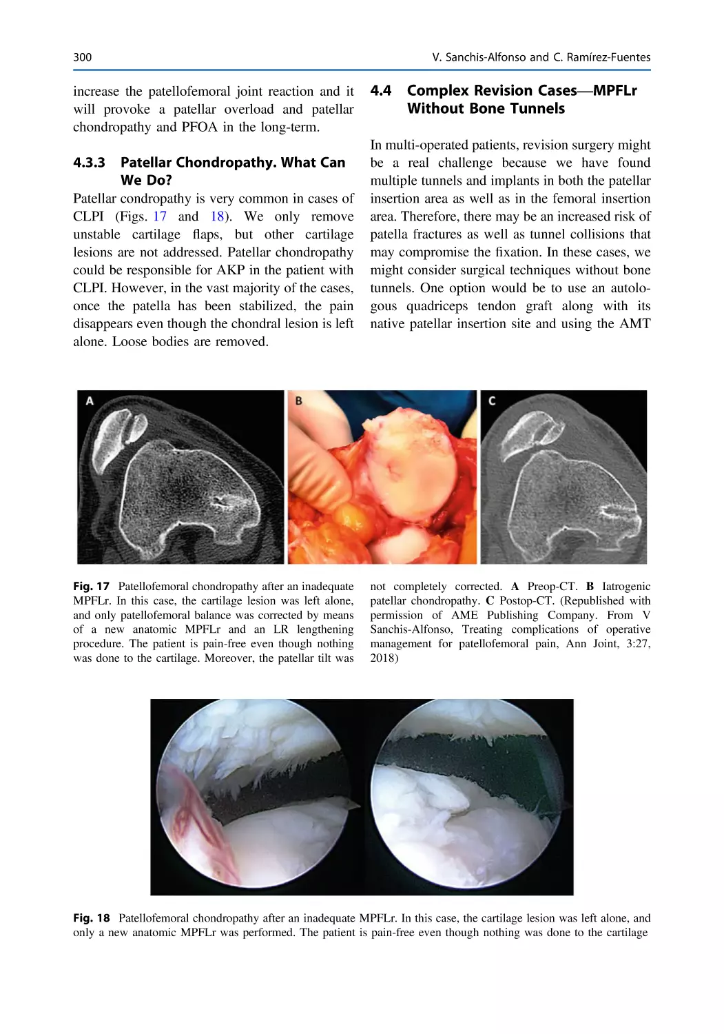 4.3.3 Patellar Chondropathy. What Can We Do?
4.4 Complex Revision Cases—MPFLr Without Bone Tunnels