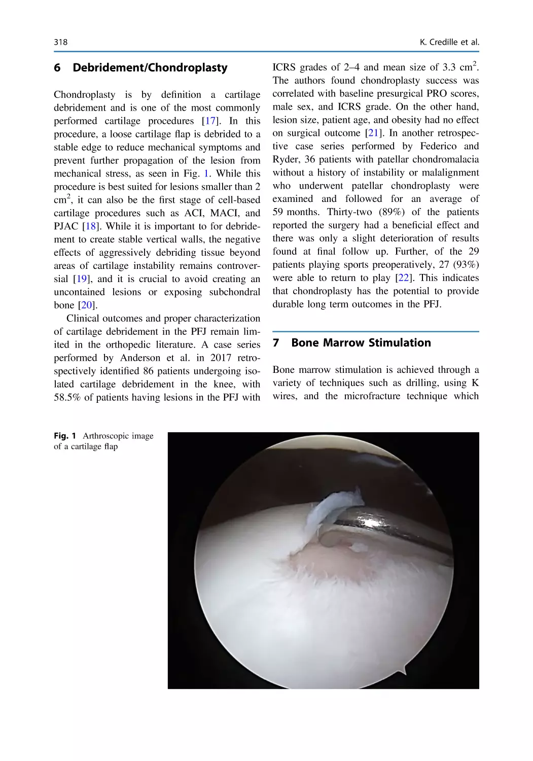 6 Debridement/Chondroplasty
7 Bone Marrow Stimulation