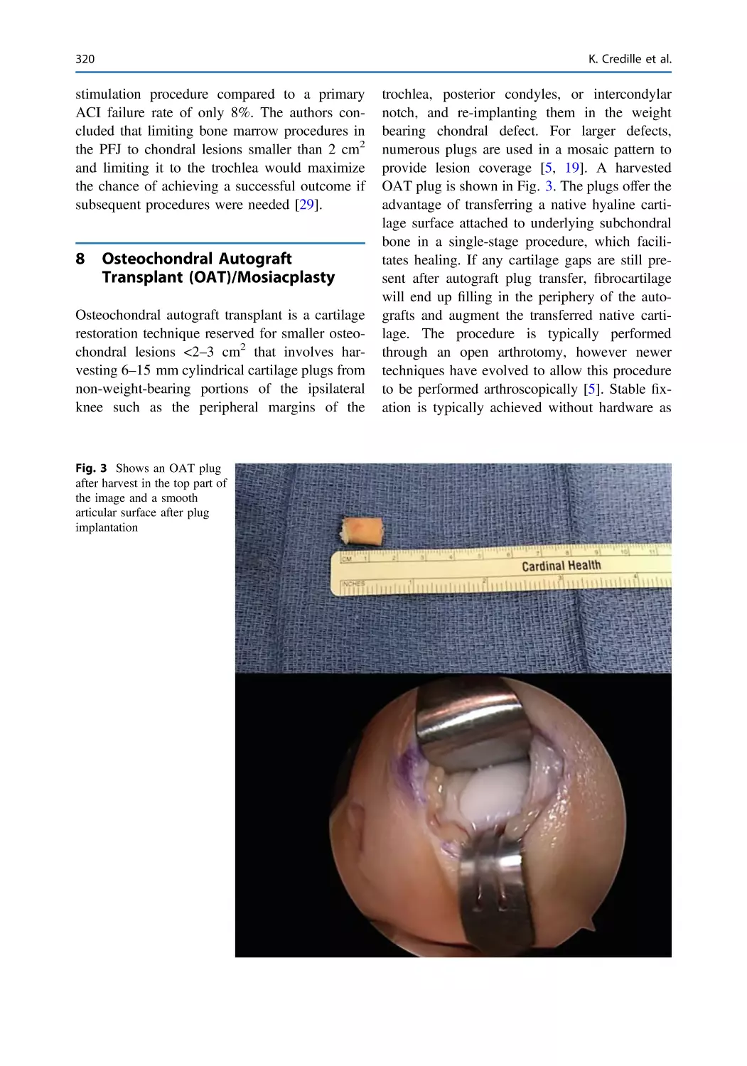 8 Osteochondral Autograft Transplant (OAT)/Mosiacplasty