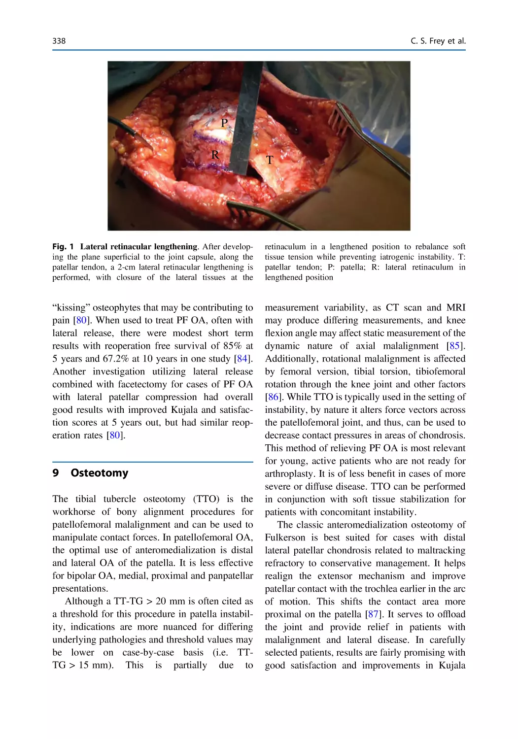 9 Osteotomy