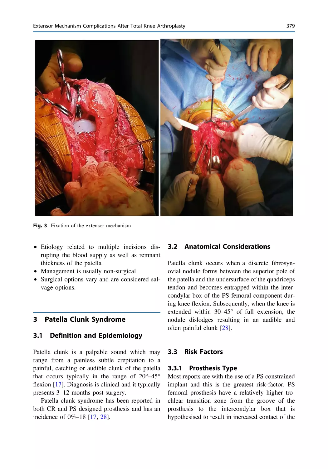 3 Patella Clunk Syndrome
3.1 Definition and Epidemiology
3.2 Anatomical Considerations
3.3 Risk Factors
3.3.1 Prosthesis Type