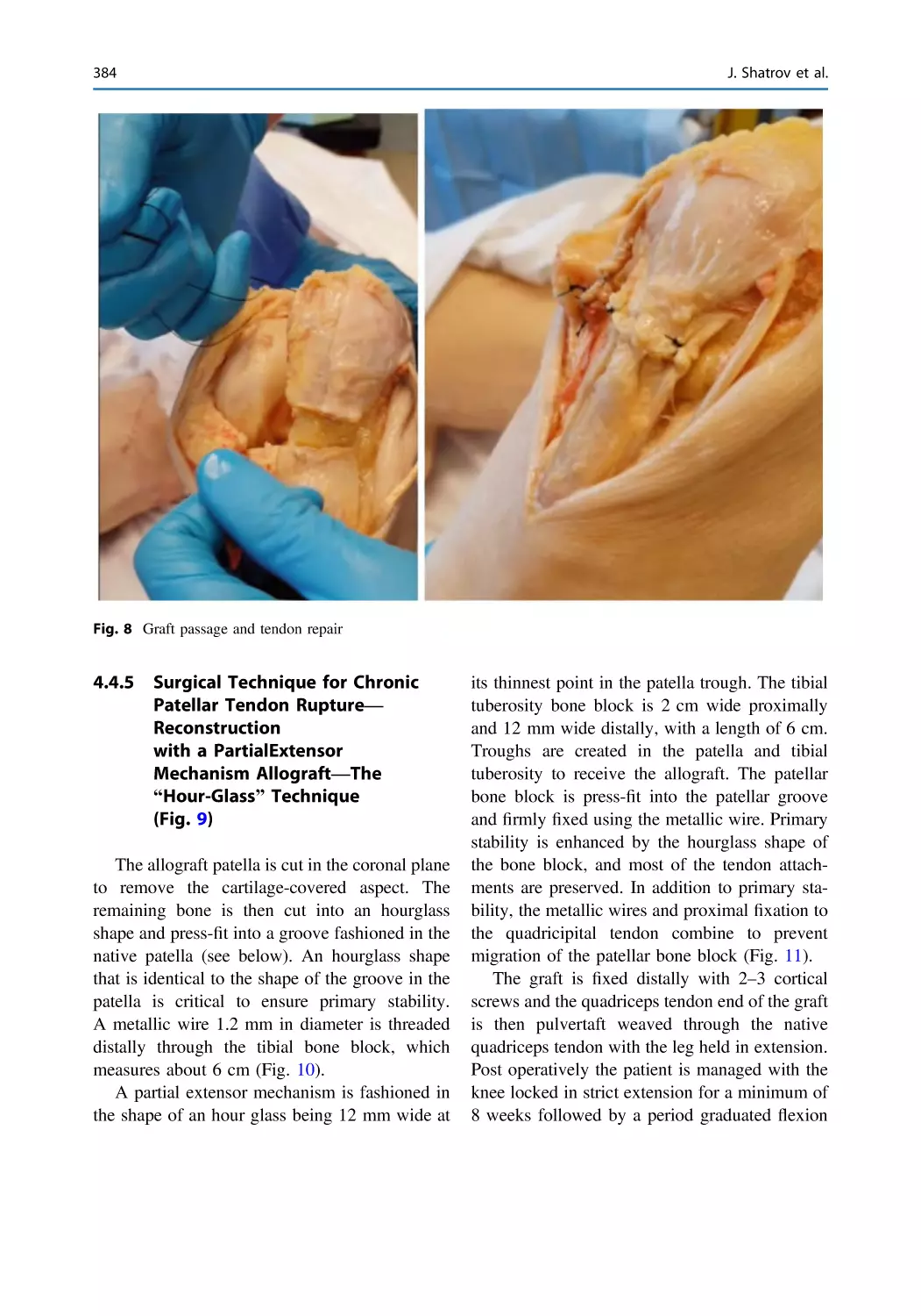 4.4.5 Surgical Technique for Chronic Patellar Tendon Rupture—Reconstruction with a PartialExtensor Mechanism Allograft—The “Hour-Glass” Technique (Fig. 9)