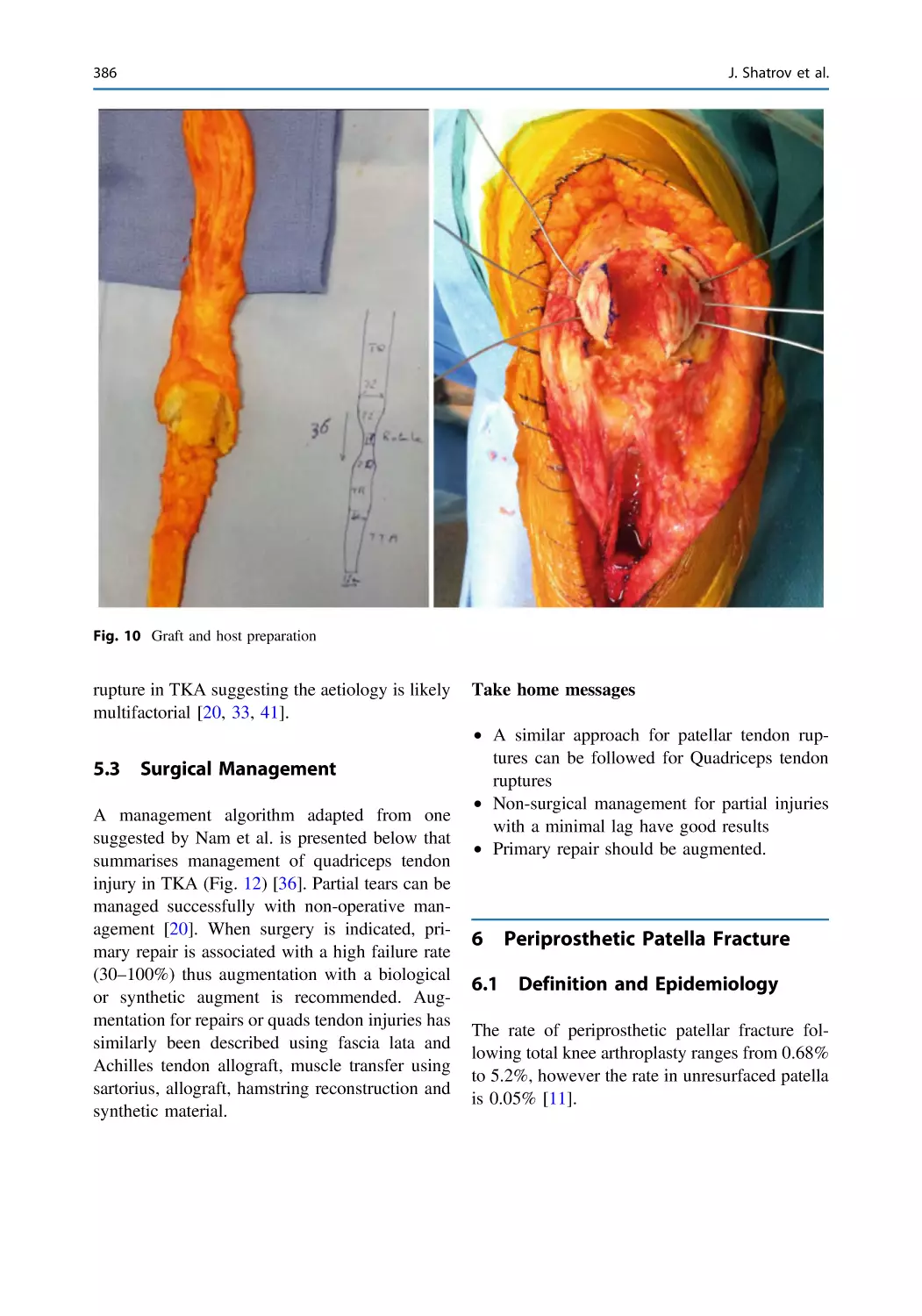 5.3 Surgical Management
6 Periprosthetic Patella Fracture
6.1 Definition and Epidemiology