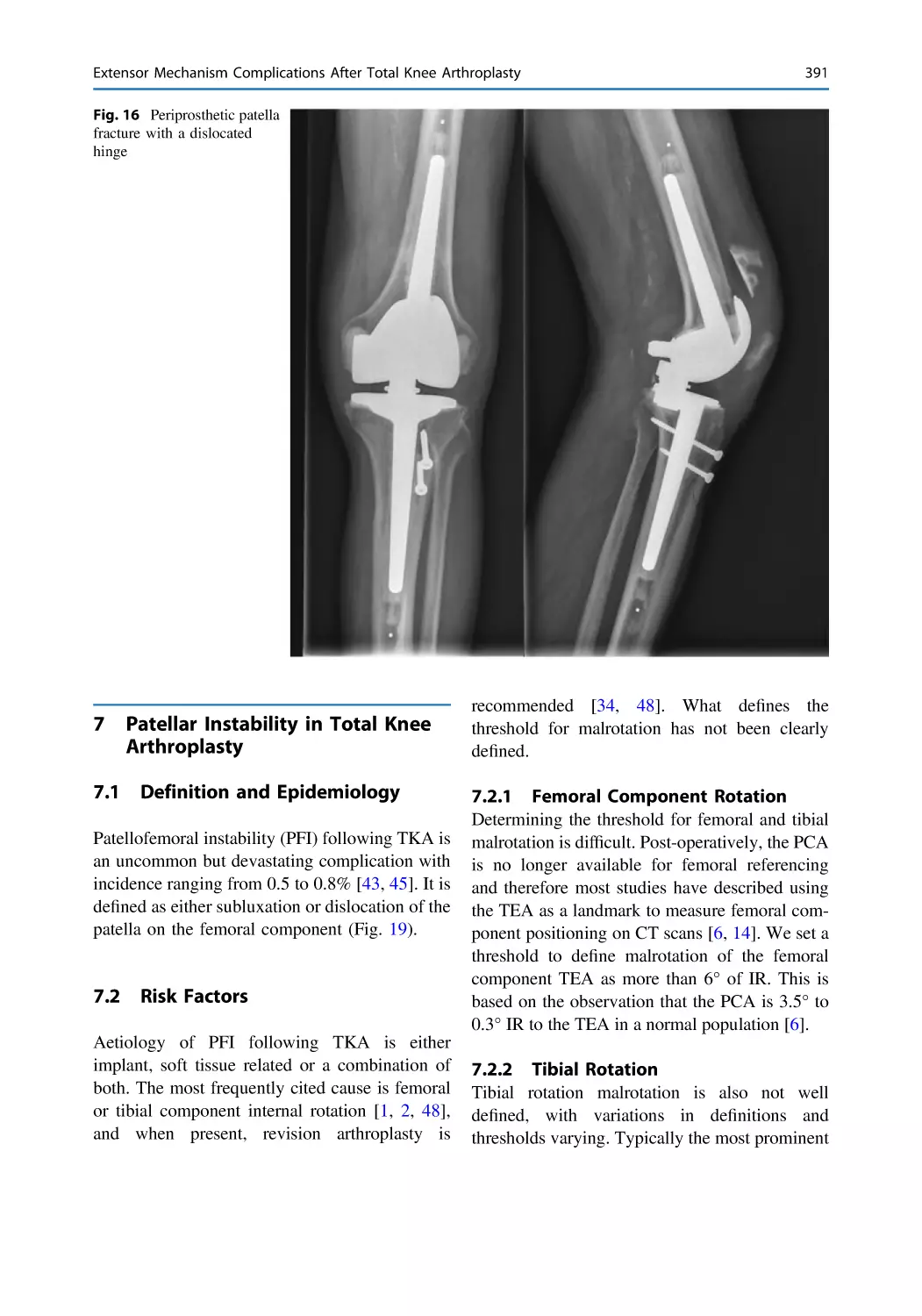 7 Patellar Instability in Total Knee Arthroplasty
7.1 Definition and Epidemiology
7.2 Risk Factors
7.2.1 Femoral Component Rotation
7.2.2 Tibial Rotation