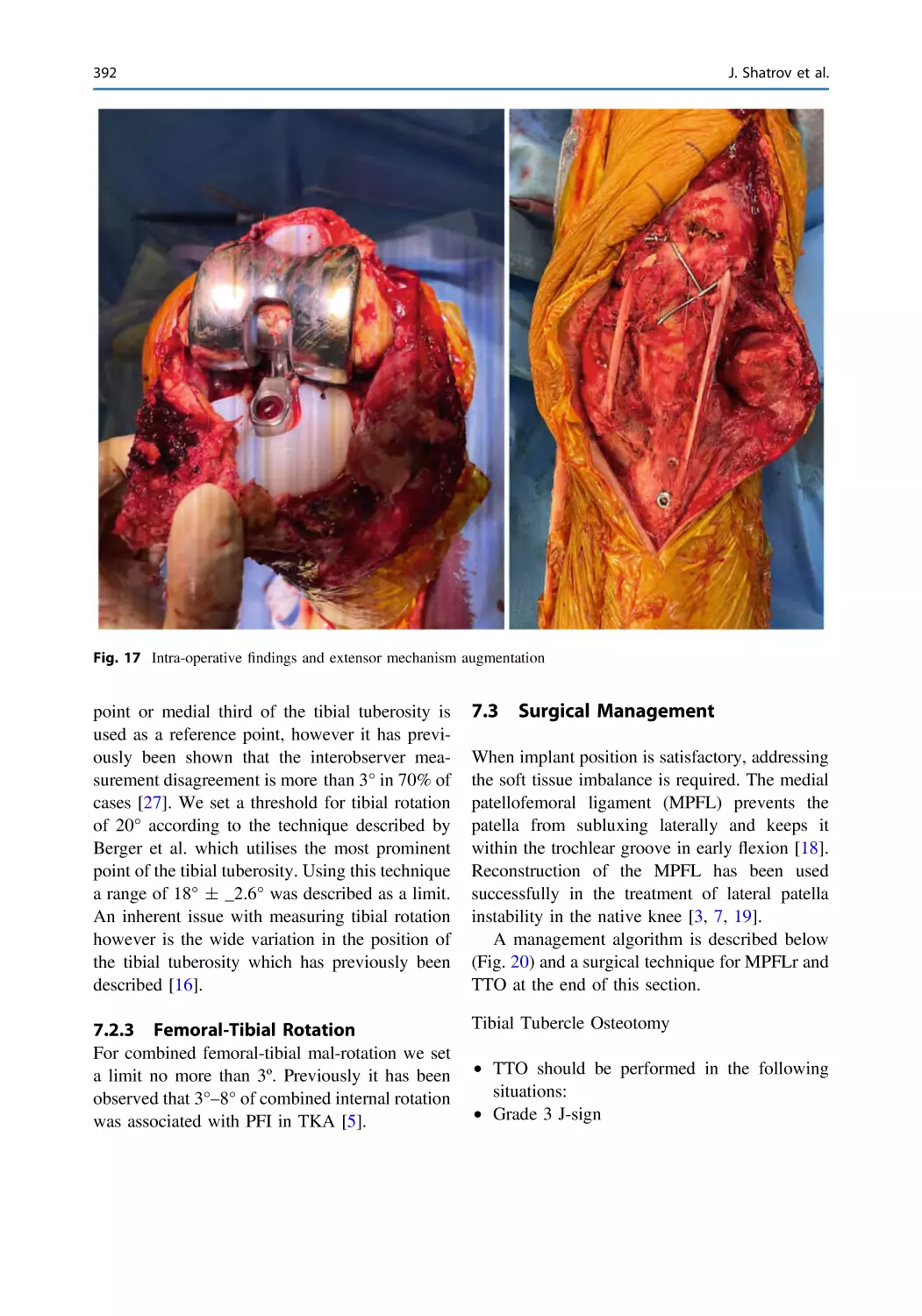 7.2.3 Femoral-Tibial Rotation
7.3 Surgical Management