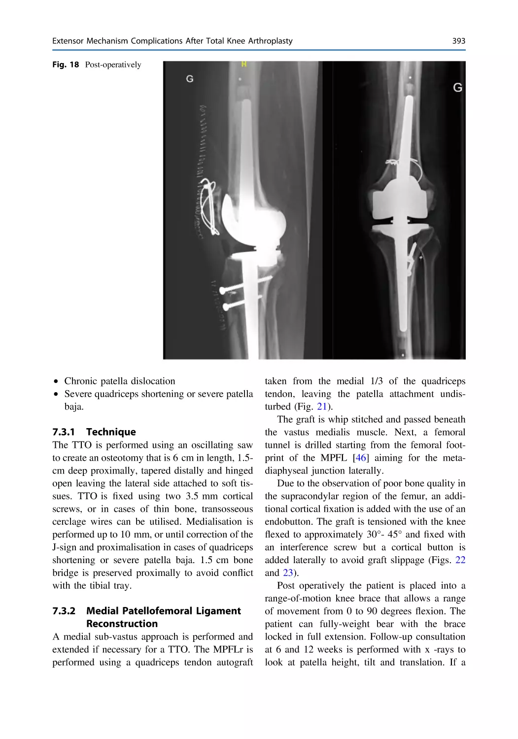 7.3.1 Technique
7.3.2 Medial Patellofemoral Ligament Reconstruction