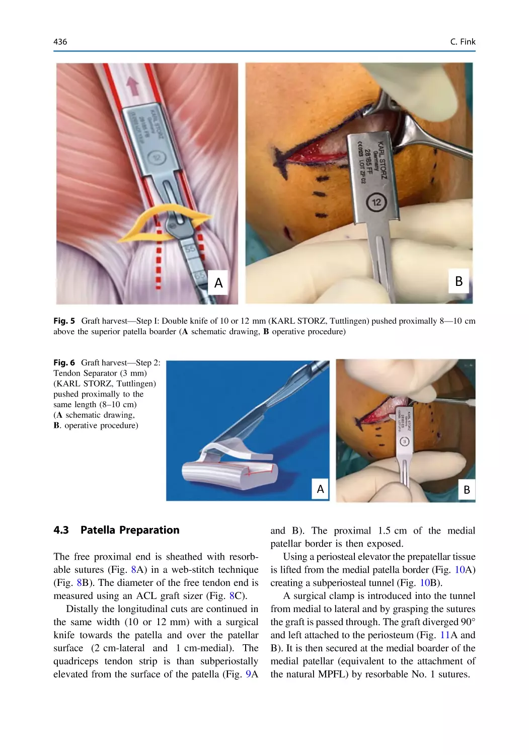 4.3 Patella Preparation