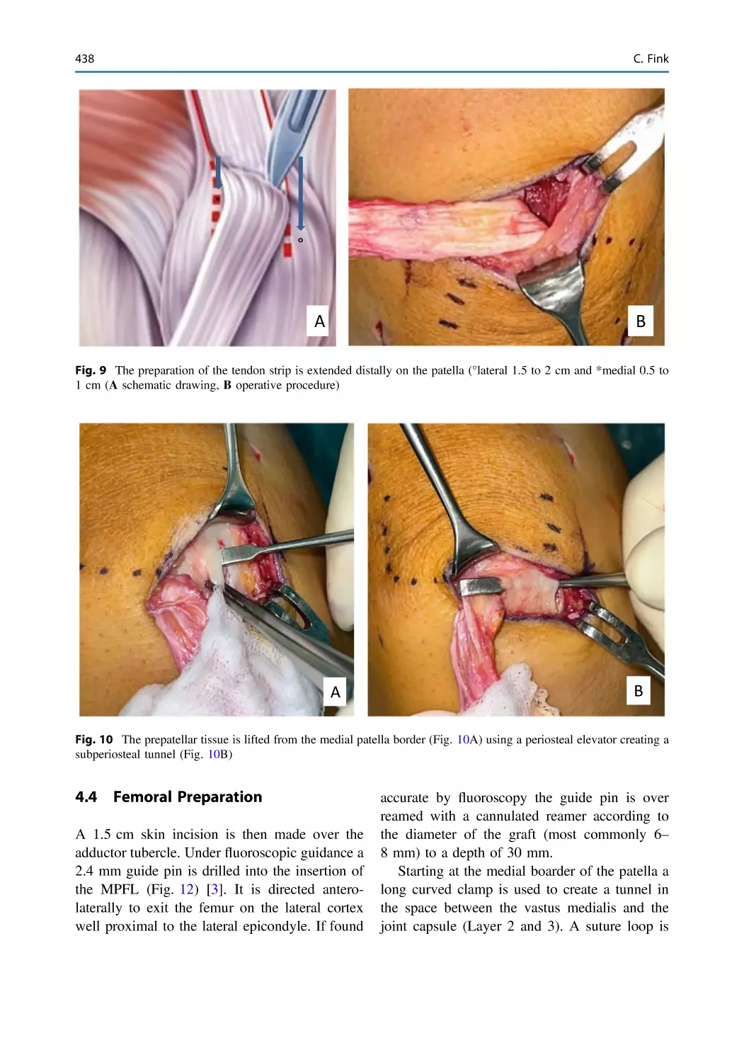 4.4 Femoral Preparation