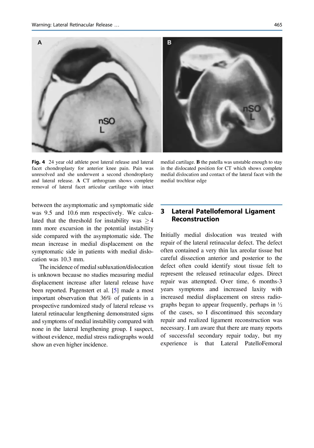 3 Lateral Patellofemoral Ligament Reconstruction