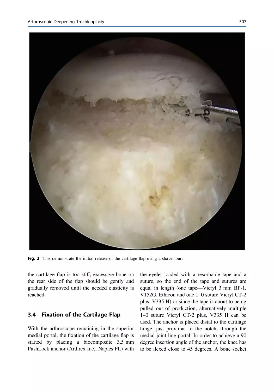 3.4 Fixation of the Cartilage Flap