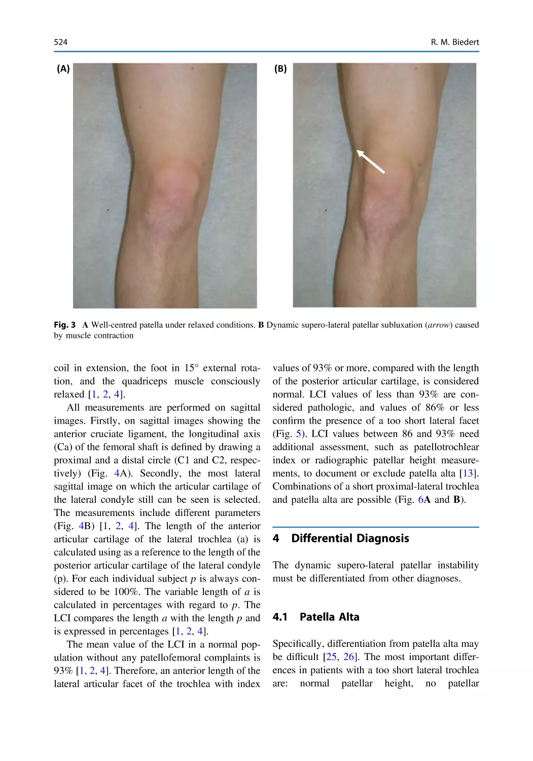 4 Differential Diagnosis
4.1 Patella Alta