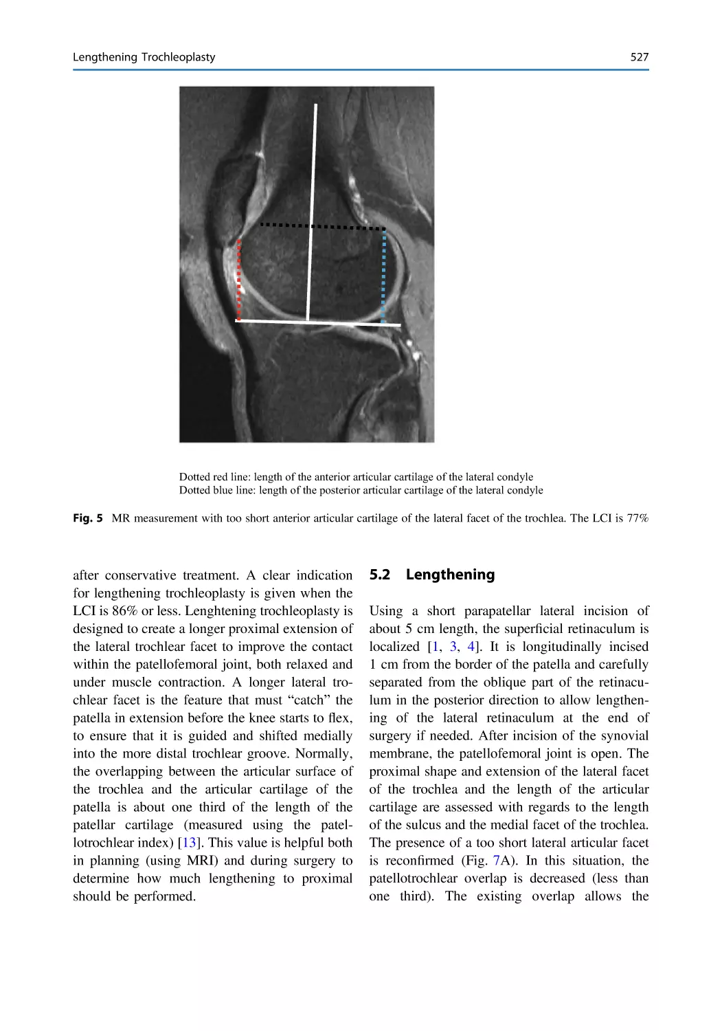 5.2 Lengthening